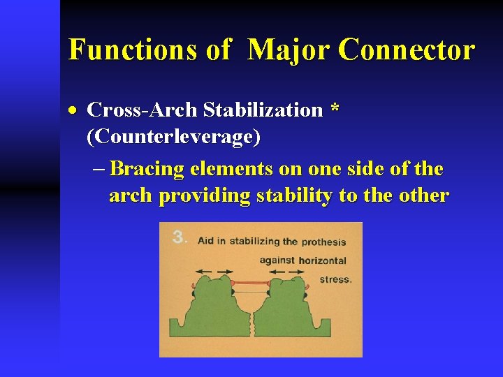 Functions of Major Connector · Cross-Arch Stabilization * (Counterleverage) - Bracing elements on one
