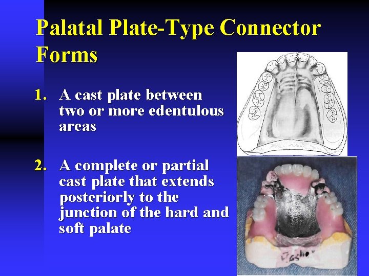Palatal Plate-Type Connector Forms 1. A cast plate between two or more edentulous areas