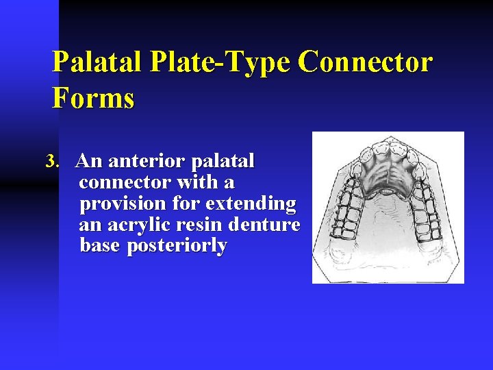 Palatal Plate-Type Connector Forms 3. An anterior palatal connector with a provision for extending