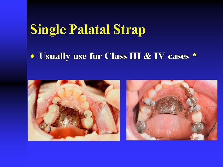 Single Palatal Strap · Usually use for Class III & IV cases * 