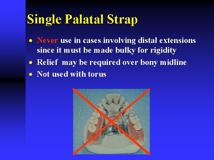 Single Palatal Strap · Never use in cases involving distal extensions since it must