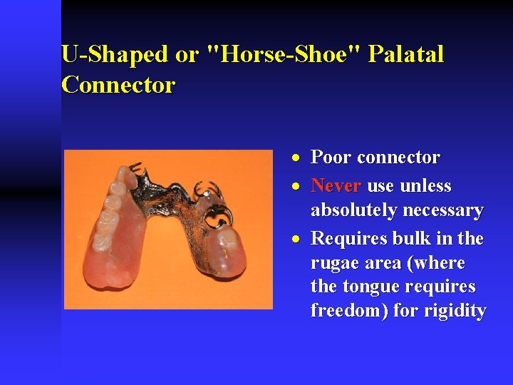 U-Shaped or "Horse-Shoe" Palatal Connector · Poor connector · Never use unless absolutely necessary