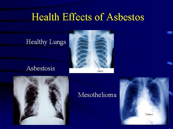 Health Effects of Asbestos Healthy Lungs Asbestosis Mesothelioma 