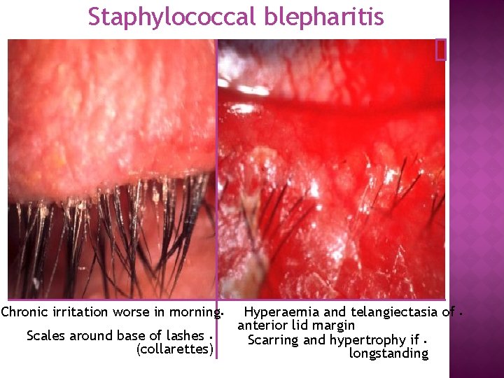 Staphylococcal blepharitis Chronic irritation worse in morning • Scales around base of lashes •