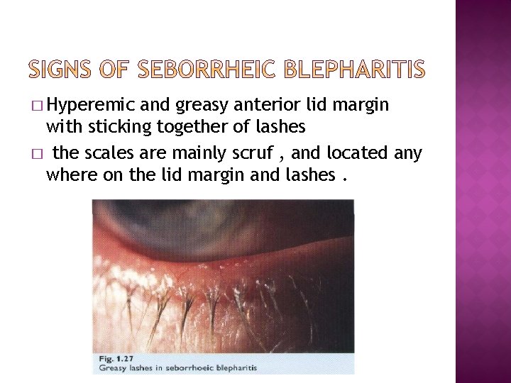 � Hyperemic and greasy anterior lid margin with sticking together of lashes � the