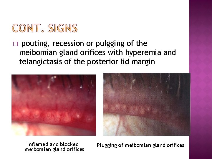 � pouting, recession or pulgging of the meibomian gland orifices with hyperemia and telangictasis