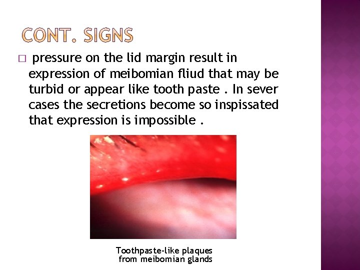 � pressure on the lid margin result in expression of meibomian fliud that may