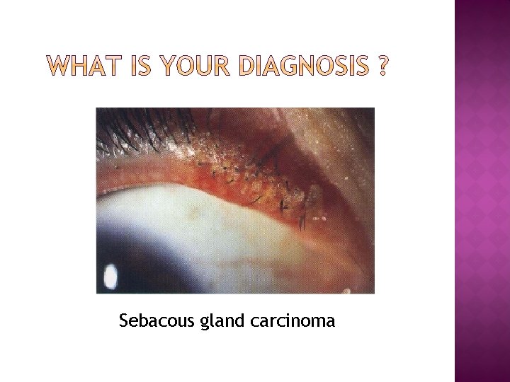 Sebacous gland carcinoma 