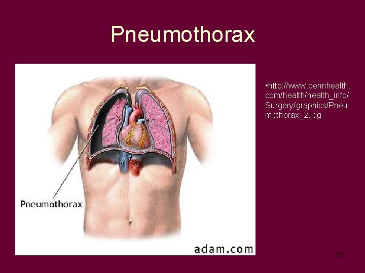 Pneumothorax • http: //www. pennhealth. com/health_info/ Surgery/graphics/Pneu mothorax_2. jpg 23 