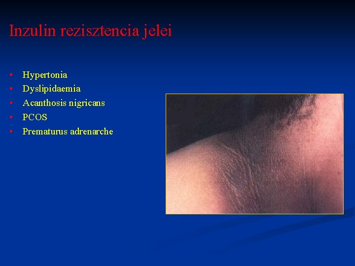 Inzulin rezisztencia jelei • • • Hypertonia Dyslipidaemia Acanthosis nigricans PCOS Prematurus adrenarche 