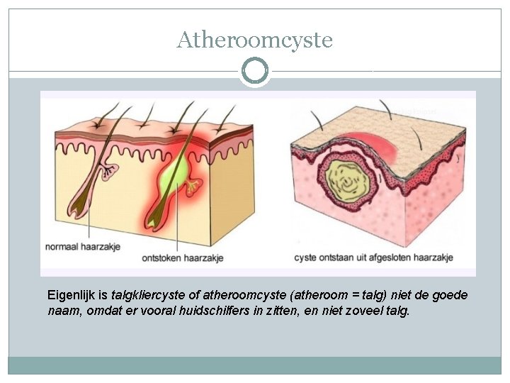 Atheroomcyste Eigenlijk is talgkliercyste of atheroomcyste (atheroom = talg) niet de goede naam, omdat
