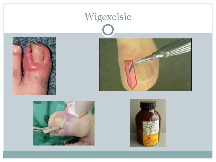 Wigexcisie 