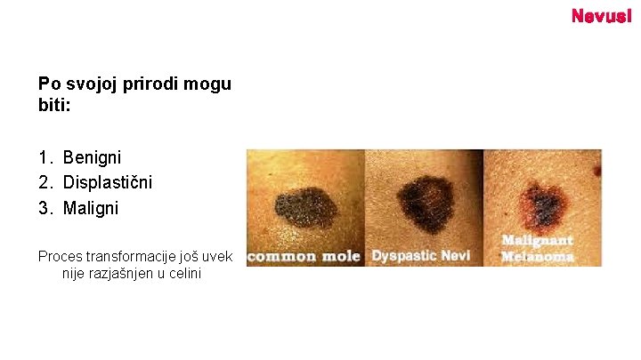 Nevusi Po svojoj prirodi mogu biti: 1. Benigni 2. Displastični 3. Maligni Proces transformacije