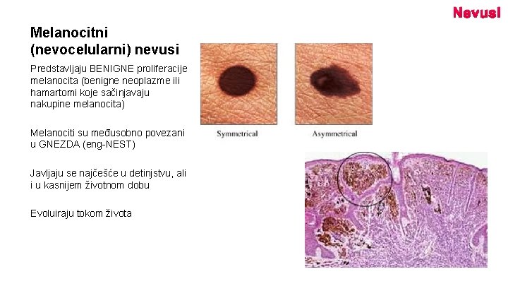 Nevusi Melanocitni (nevocelularni) nevusi Predstavljaju BENIGNE proliferacije melanocita (benigne neoplazme ili hamartomi koje sačinjavaju