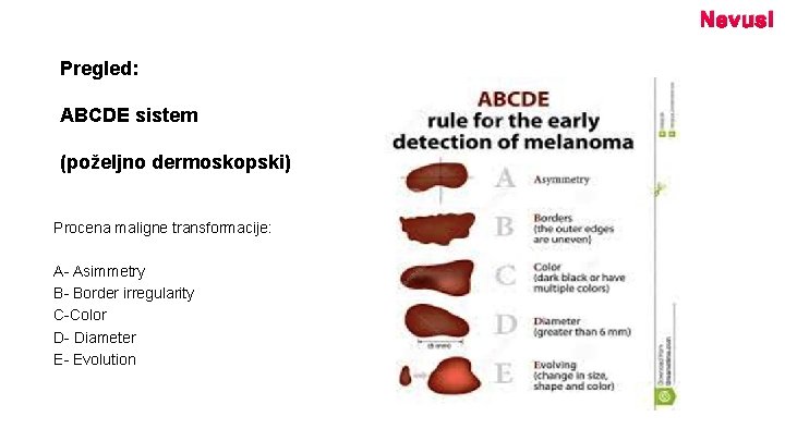 Nevusi Pregled: ABCDE sistem (poželjno dermoskopski) Procena maligne transformacije: A- Asimmetry B- Border irregularity