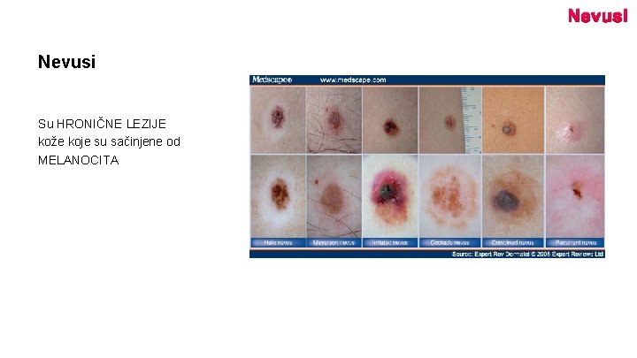 Nevusi Su HRONIČNE LEZIJE kože koje su sačinjene od MELANOCITA 