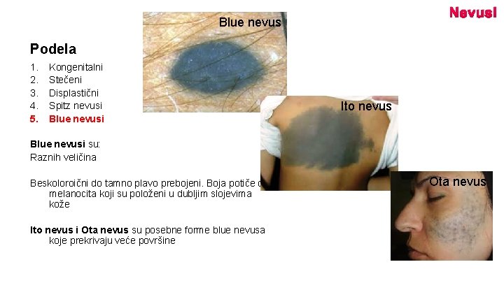 Nevusi Blue nevus Podela 1. 2. 3. 4. 5. Kongenitalni Stečeni Displastični Spitz nevusi