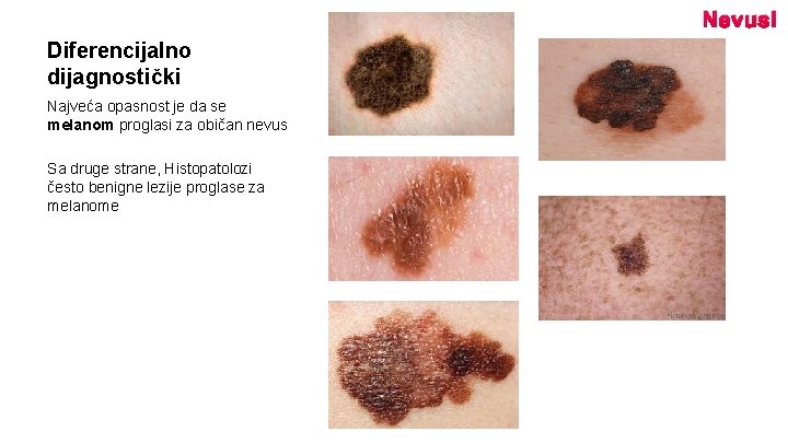 Nevusi Diferencijalno dijagnostički Najveća opasnost je da se melanom proglasi za običan nevus Sa