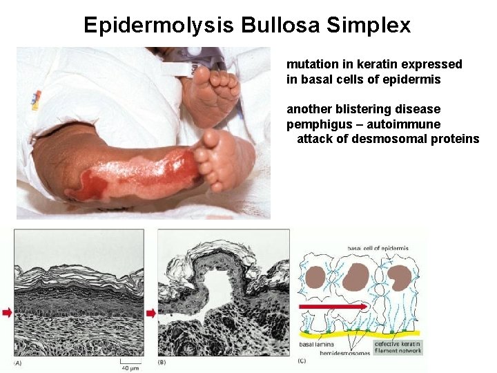 Epidermolysis Bullosa Simplex mutation in keratin expressed in basal cells of epidermis another blistering