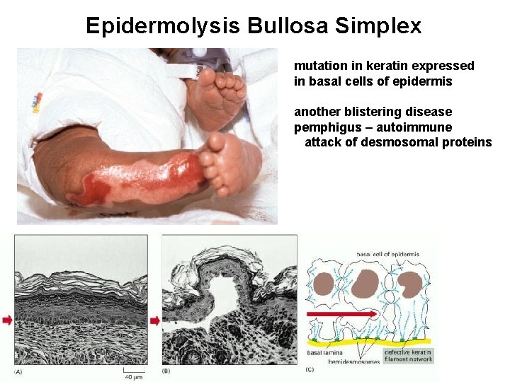 Epidermolysis Bullosa Simplex mutation in keratin expressed in basal cells of epidermis another blistering