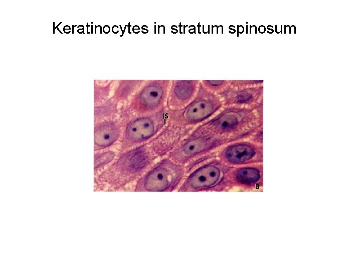 Keratinocytes in stratum spinosum 