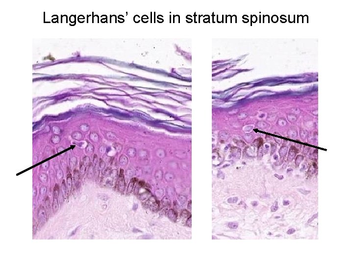 Langerhans’ cells in stratum spinosum 