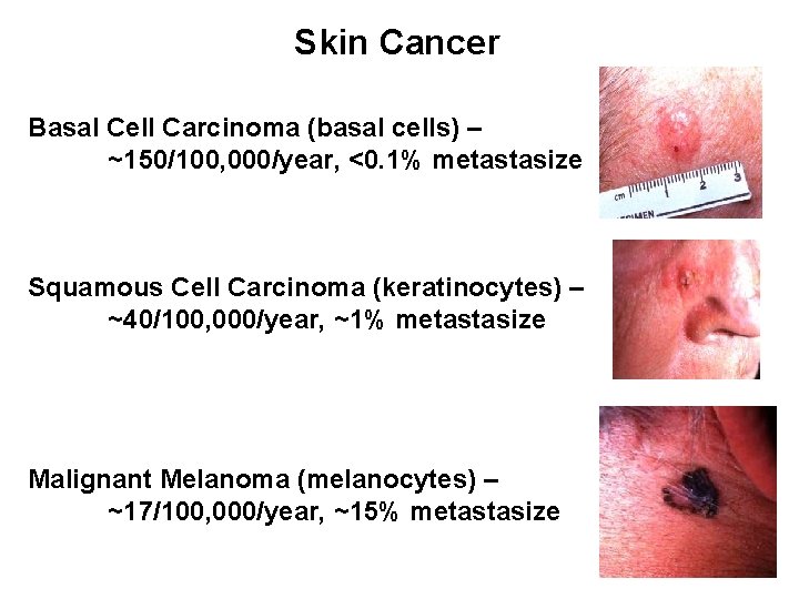 Skin Cancer Basal Cell Carcinoma (basal cells) – ~150/100, 000/year, <0. 1% metastasize Squamous