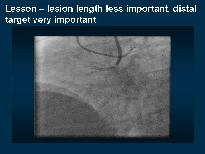 Lesson – lesion length less important, distal target very important 