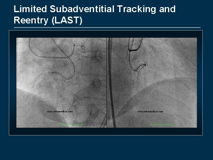 Limited Subadventitial Tracking and Reentry (LAST) 