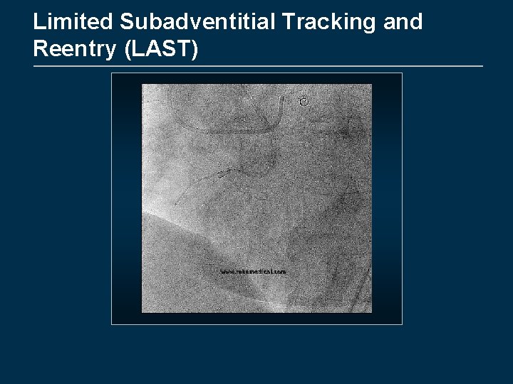 Limited Subadventitial Tracking and Reentry (LAST) 