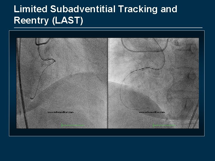 Limited Subadventitial Tracking and Reentry (LAST) 