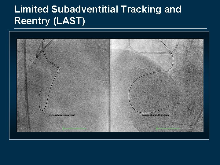 Limited Subadventitial Tracking and Reentry (LAST) 