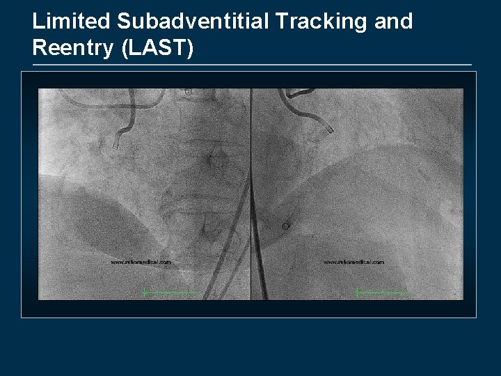 Limited Subadventitial Tracking and Reentry (LAST) 