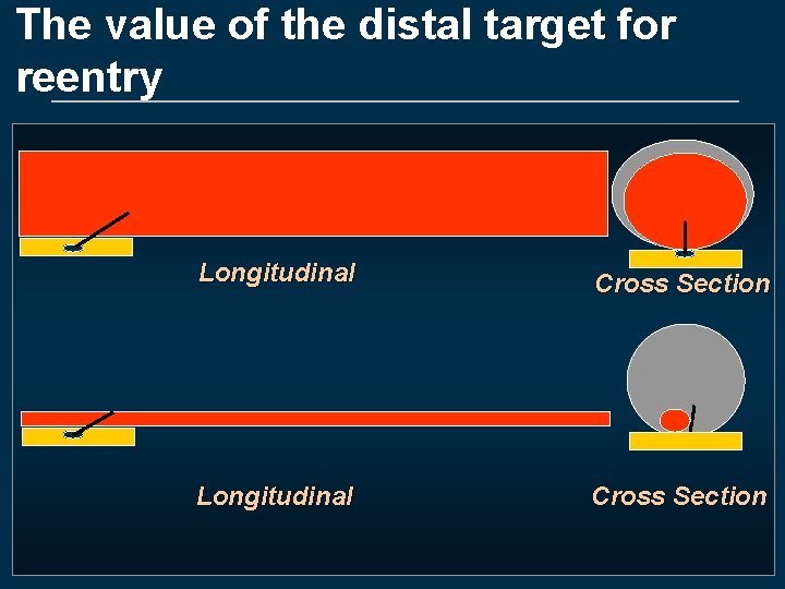 The value of the distal target for reentry Longitudinal Cross Section 