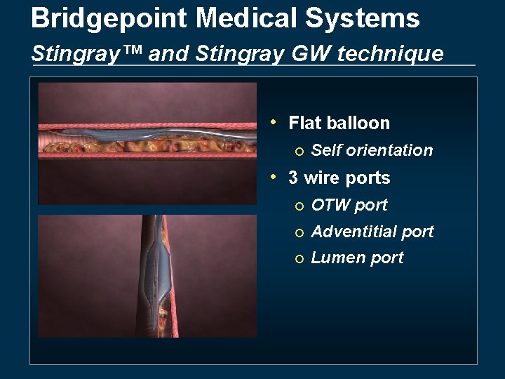 Bridgepoint Medical Systems Stingray™ and Stingray GW technique • Flat balloon ¡ Self orientation