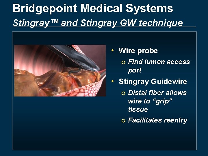 Bridgepoint Medical Systems Stingray™ and Stingray GW technique • Wire probe ¡ Find lumen