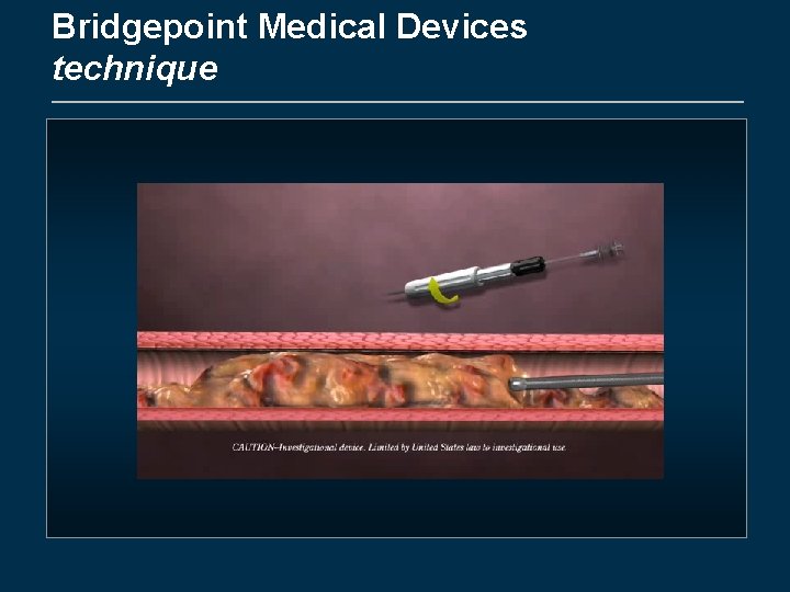 Bridgepoint Medical Devices technique 