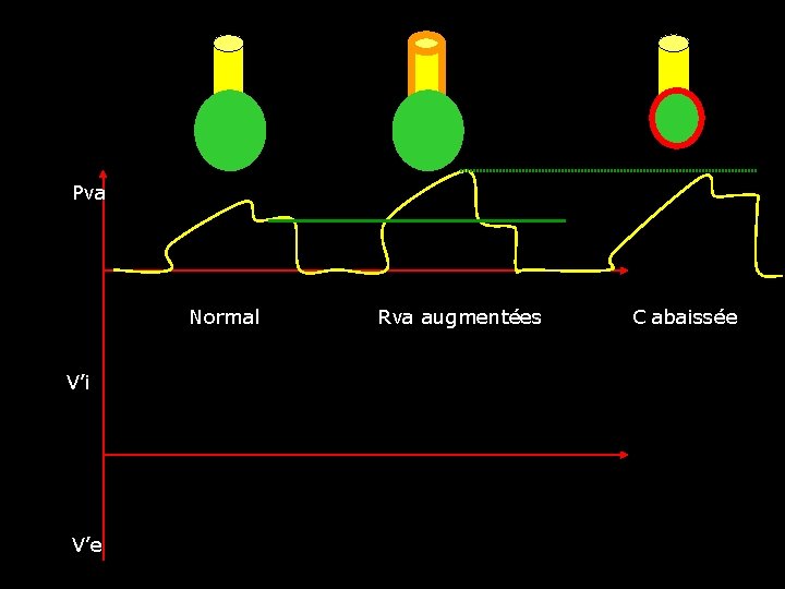 Pva Normal Rva augmentées C abaissée V’i V’e 