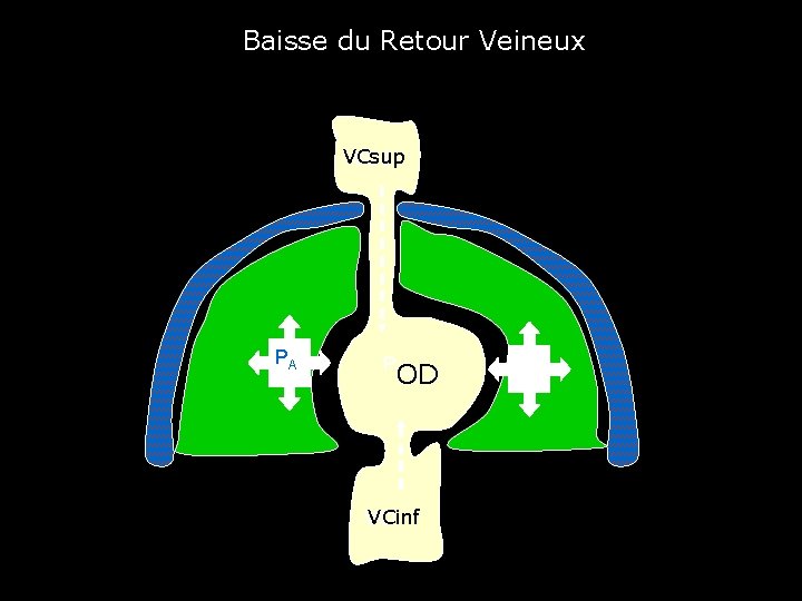Baisse du Retour Veineux VCsup VCS PA POD OD VCinf VCI 