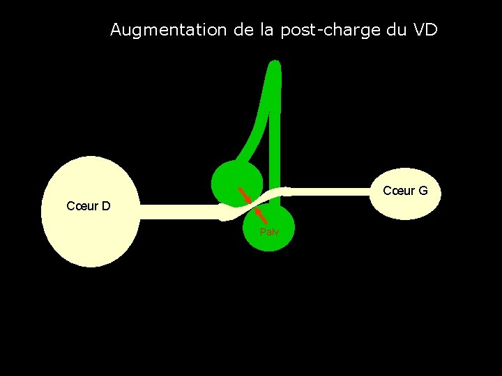 Augmentation de la post-charge du VD Cœur G Cœur D Palv 