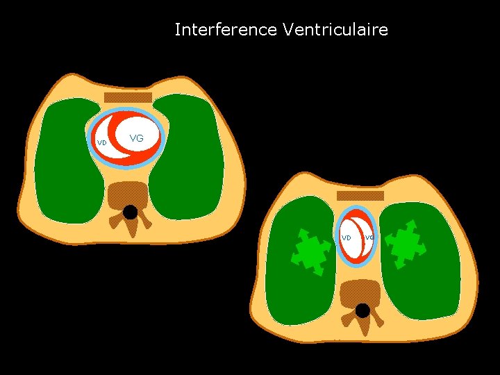 Interference Ventriculaire VD VG 