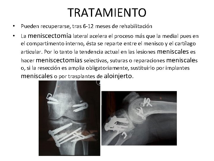 TRATAMIENTO • Pueden recuperarse, tras 6 -12 meses de rehabilitación • La meniscectomía lateral