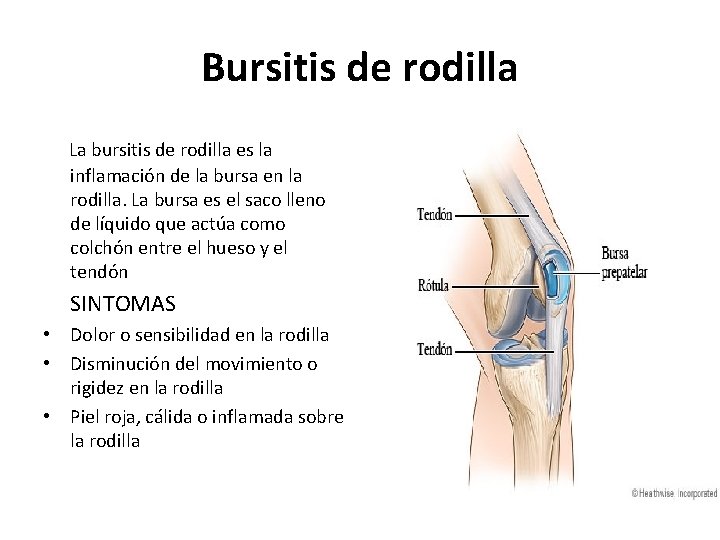 Bursitis de rodilla La bursitis de rodilla es la inflamación de la bursa en