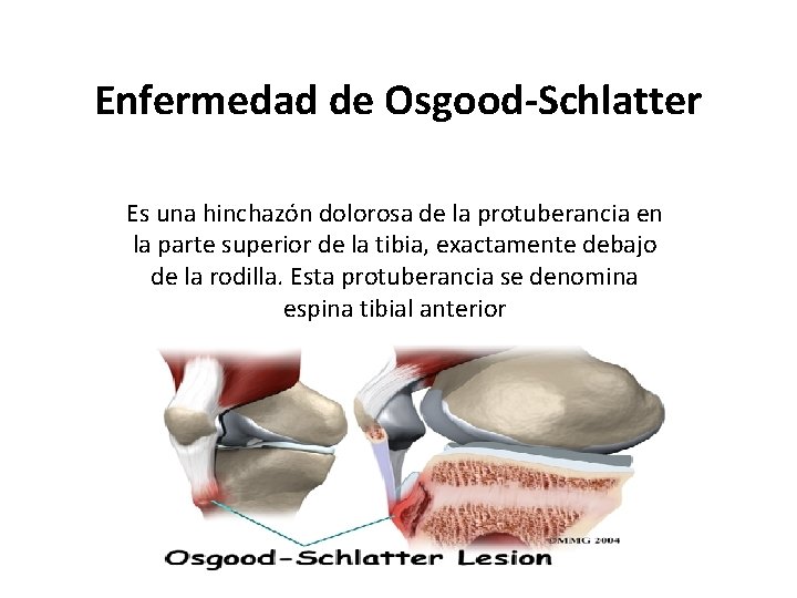 Enfermedad de Osgood-Schlatter Es una hinchazón dolorosa de la protuberancia en la parte superior