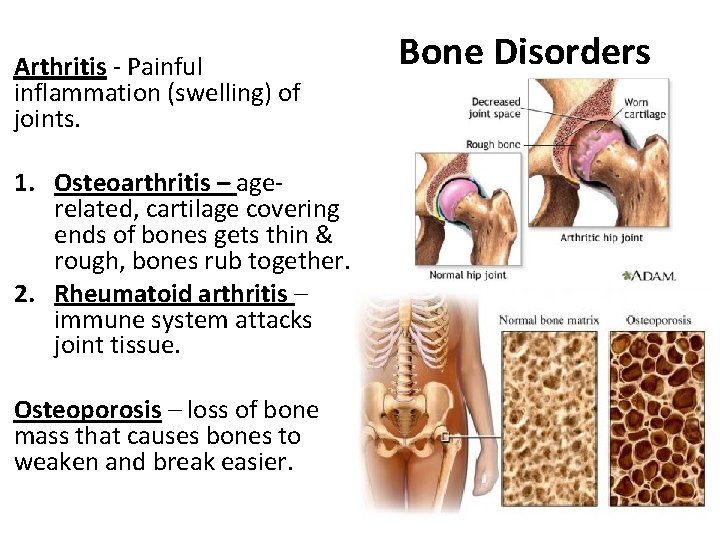 Arthritis - Painful inflammation (swelling) of joints. 1. Osteoarthritis – agerelated, cartilage covering ends