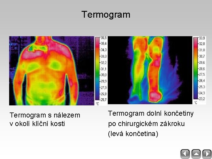 Termogram s nálezem v okolí klíční kosti Termogram dolní končetiny po chirurgickém zákroku (levá