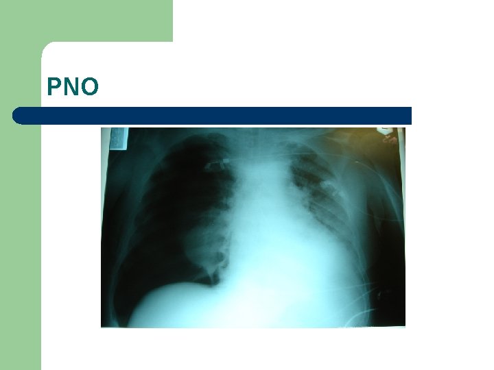 PNO 