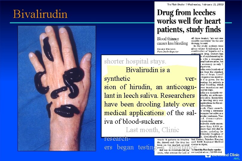 Bivalirudin shorter hospital stays. Bivalirudin is a synthetic version of hirudin, an anticoagulant in