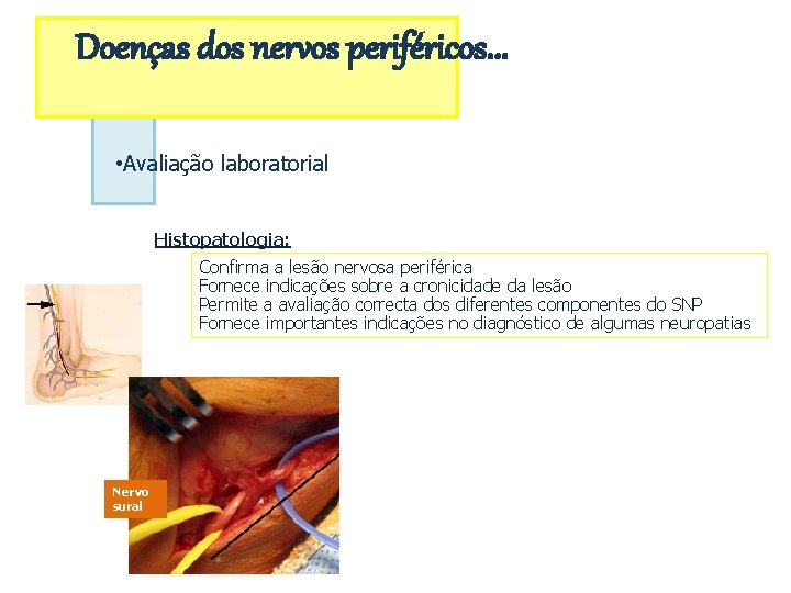 Doenças dos nervos periféricos. . . • Avaliação laboratorial Histopatologia: Confirma a lesão nervosa