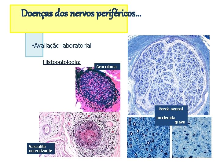 Doenças dos nervos periféricos. . . • Avaliação laboratorial Histopatologia: Granuloma Perda axonal moderada